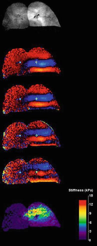 Magnetic Resonance Elastography Of The Lungs Radiology Key