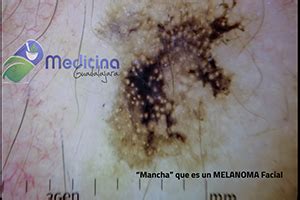 Cancer De Piel Lunares Y Melanoma Gu A Completa Para Entender Y