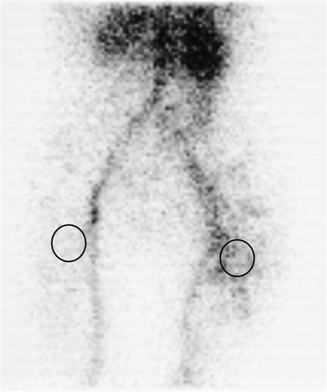 Diagnosis Of Peri Prosthetic Infection At The Hip Using Triple Phase