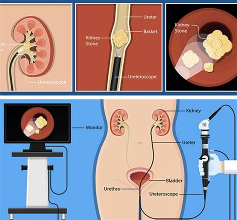 Ureteroscopic Lithotripsy