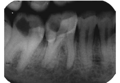 Preoperative Intraoral Periapical Radiograph Of 46 Showing Distal