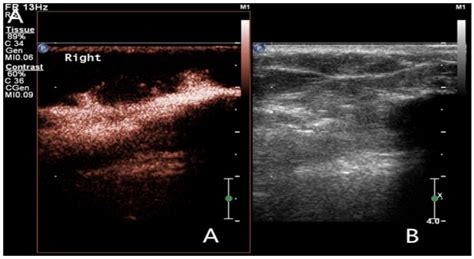 Ultrasound Guided Vacuum Assisted Breast Complete Duct Excision A