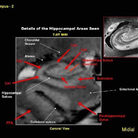 eso es todo Municipios Acción de gracias hippocampus anatomy mri