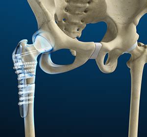 Hip Fracture Surgery Lewisburg Wv Hip Fracture Ronceverte Wv