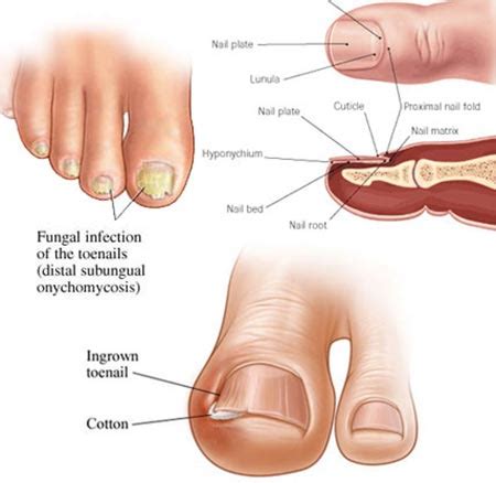 Toenail Fungus Treatment in NYC | Manhattan Foot Specialists