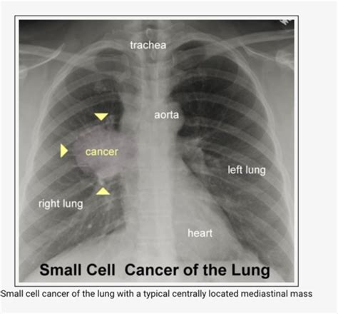 Pulmonology Flashcards Quizlet