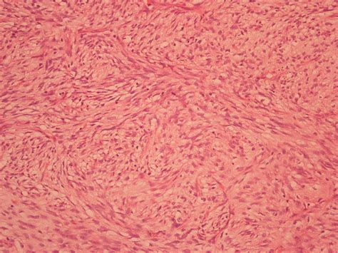 Liposarcoma Pathophysiology Wikidoc