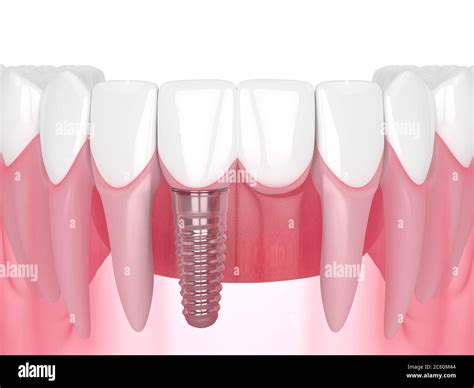 3d render of jaw with dental incisor cantilever bridge supported by ...