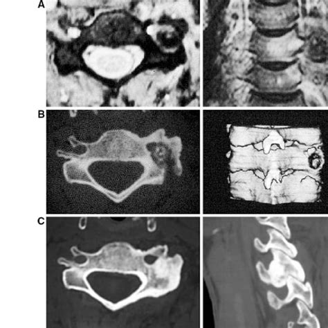 Pdf Osteoid Osteoma Of The Cervical Spine Surgical Treatment Or