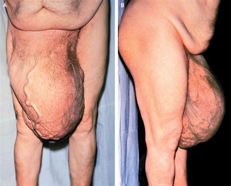 Hernia Left Untreated Descent Of Intestines Into Testicle Sack Imgur