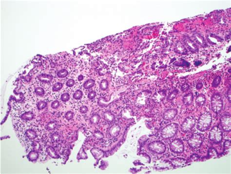 Colonic Mucosa From The Biopsy Shows Areas Of Ulceration Acute