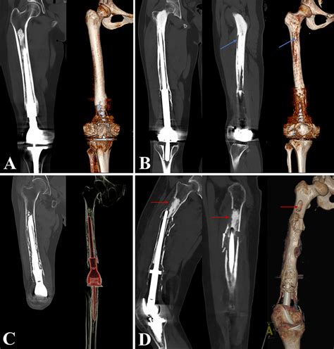 4 Grades Of Femoral Bone Loss After Aseptic Loosening Grade I Minimal Download Scientific