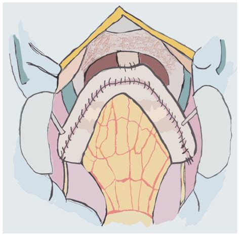 Advances In Urinary Diversion From Cutaneous Ureterostomy To