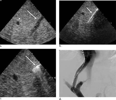 Transjugular Intrahepatic Portosystemic Shunt Creation Using Intravascular Ultrasound Guidance