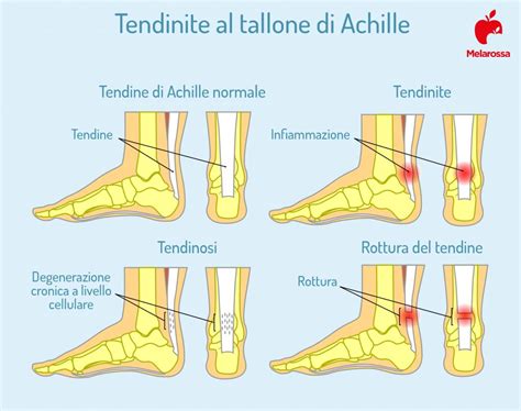 Tendinite Cos Cause Sintomi Cure E Decorso Melarossa