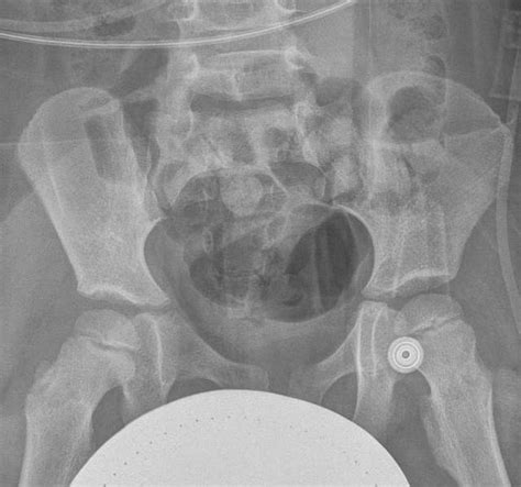 X Ray Of The Pelvis Of A 3 Year Old Male Case 3 Anteroposterior