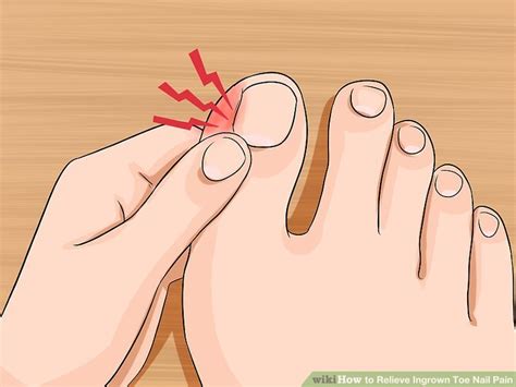 Ways To Relieve Ingrown Toe Nail Pain Wikihow