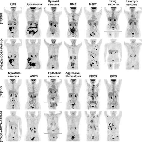 Mip Images Of F Fdg Pet Ct And Ga Ga Dota Fapi Pet Ct In