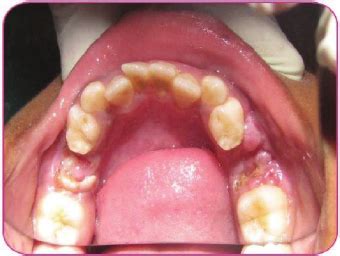 Orthopantomograph Showing Mandibular Left Primary Second Molar