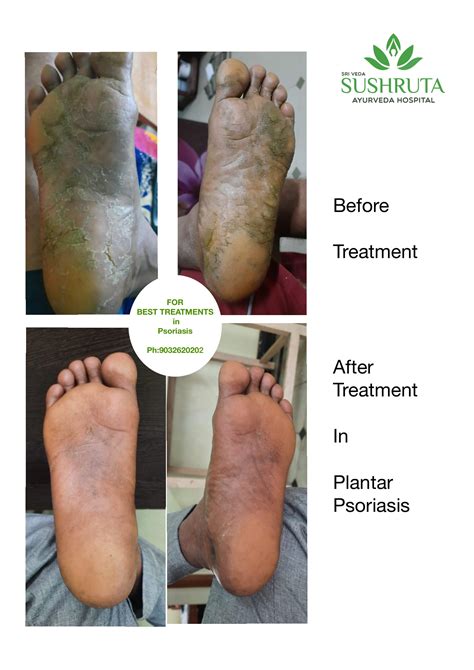 Plantar Psoriasis Before and After | Sushruta Ayurveda Hospital