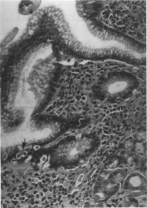 H Pylori Associated Chronic Gastritis Of The Fundus Showing Moderate