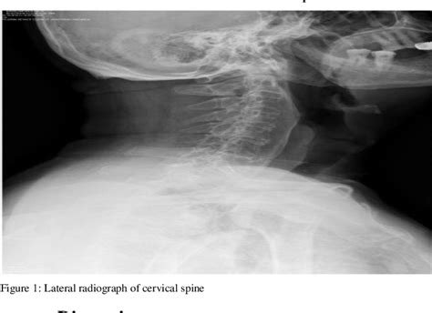 Figure 1 From Neck Pain And Dysphagia Secondary To Diffuse Idiopathic Skeletal Hyperostosis Of