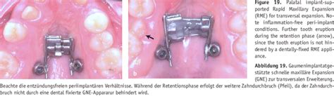 Palatal Implant Supported Rapid Maxillary Expansion Rme For