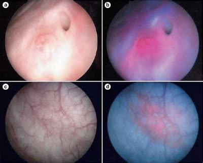 Cystoscopy for Bladder Cancer – Urology Care of Central New Jersey