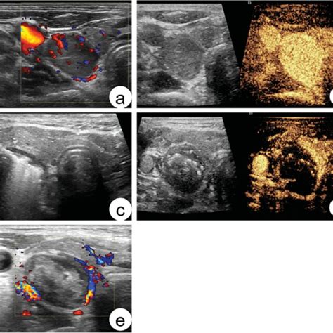 Sonogram Of Parathyroid Adenoma Before And After Mwa A 56 Year Old