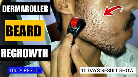 How To Use Derma Roller For Beard Growth Derma Roller Beard Regrowth Tips For Beard Growth