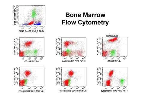 Acute Megakaryoblastic Leukemia Flow Cytometry