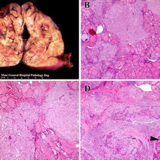 Minimally Invasive Follicular Thyroid Carcinoma Serial Sections Of The