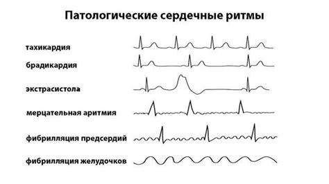Как не попасть в армию с аритмией | Категория годности при аритмии