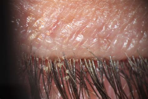 Demodex Mites On Face Pictures Photos