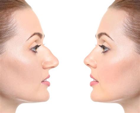 Rinoplastia Ultrasónica Clinicas Imeba®