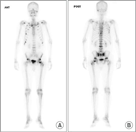 The 99mtc Hydroxymethylene Diphosphonate Whole Body Bone Scintigraphy