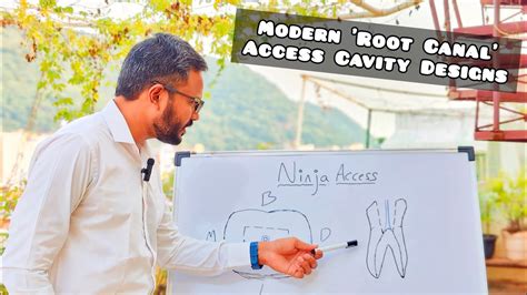 Endodontic Access Cavity Designs Ninja Access Youtube
