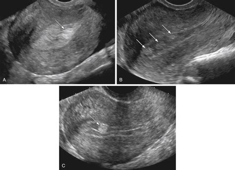 Benign Endometrial Causes Of Abnormal Bleeding Radiology Key