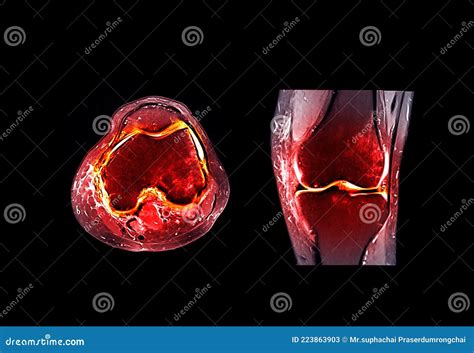 Magnetic Resonance Imaging Or Mri Knee Joint Comparison Coronal And