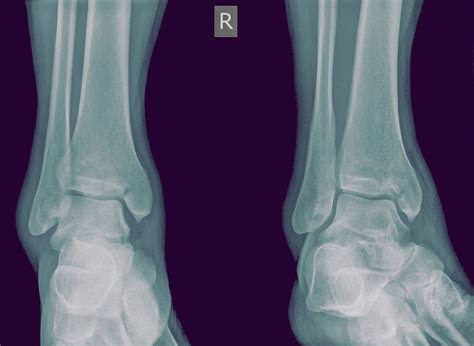 Traitement des fractures de la malléole interne et des fractures de la