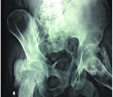 Anterior Posterior Pelvis Radiograph Showing Heterotopic Ossification Download Scientific