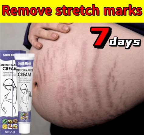 Remove Stretch Mark Cream Pregnant Cream Safe Halal Natural