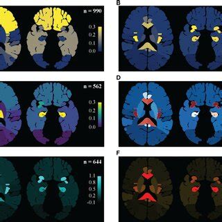 Regine Based Lesion Map Distribution Pattern Of Gliomas Were