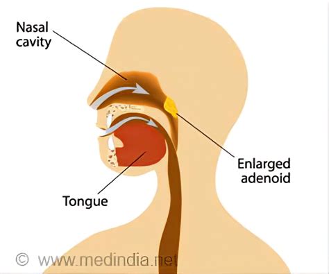 Adenoidectomy Indications Preparation Procedure Complications