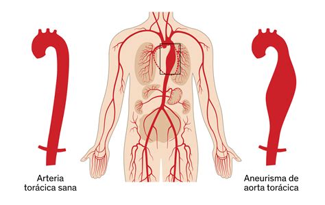 De Acuerdo A Cometer Facil De Manejar Callado De La Aorta Y Sus Ramas