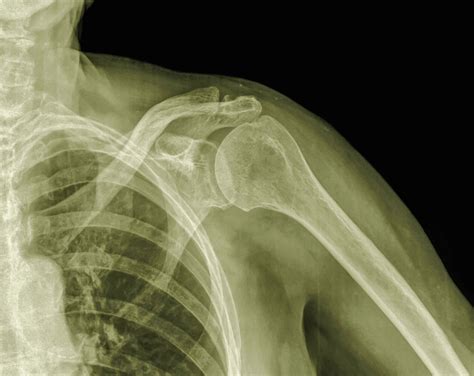 What Is Acromioclavicular Joint Arthrosis Image To U