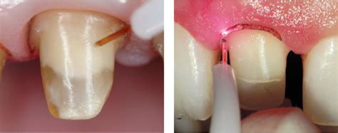 THE DIODE LASER IN FIXED PROSTHETIC RESTORATIONS AIMS AND POTENTIAL