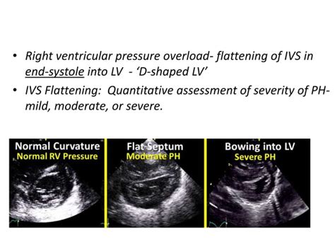 Persistent Pulmonary Hypertension Of Newborn Pphn