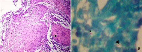 Hematoxylin Eosin And Acid Fast Staining Of The Biopsy Download Scientific Diagram