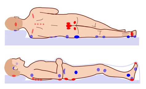 Pressure Injuries A Beginners Guide To Wound Care Management